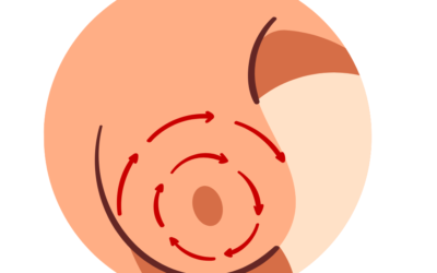 Câncer de mama é genético?