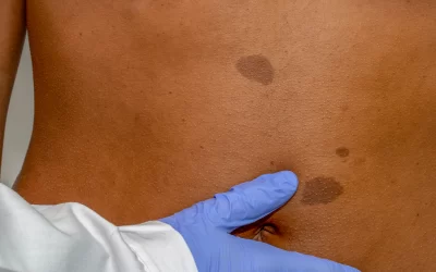 Como reconhecer a neurofibromatose tipo 2